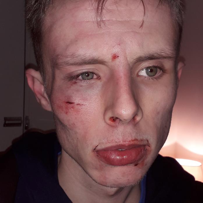ROUGH JUSTICE? Ben Matthews suffered cuts and bruises in an attack. The assailant has walked away without facing any court hearing after Durham Police decided to put him on a rehabilitation scheme for offenders, rather than prosecute. Police say this isn’